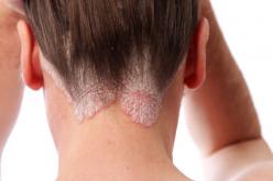 Psoriasis neck